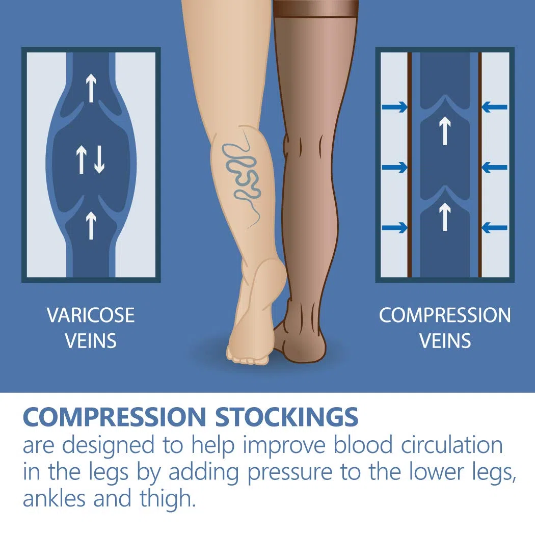 Bas de contention Elastiques Compression graduée à bout ouvert (classe médicale 2, 23-32 mmHG) pour femmes hommes Anti-thrombose Beige Small